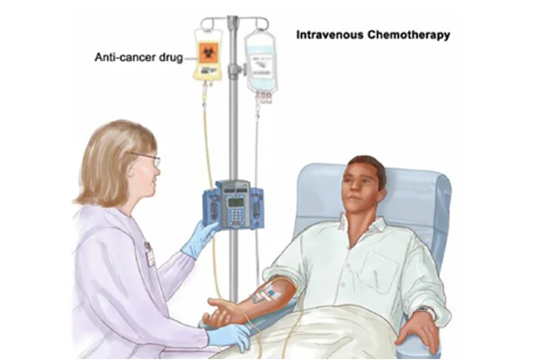 Chemotherapy